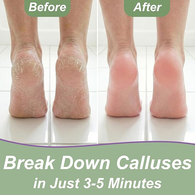 Dr. Entre's Callus Remover Gel & Foot File: Extra Strength Callus Remover for Feet, Foot Callus Remover Care, Pedicure Tools Supplies, Spa Kit, Dead Skin Scrubber, 4 oz