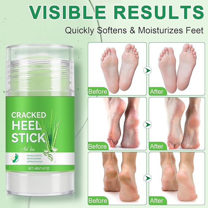 Peach+Aloe Scent Urea Cream 60% Plus Salicylic Acid 2% Foot Balm Stick for Dry Cracked/Chapped Heel, Skinned knees, Hand Intensively Hydration/Moisturization, Callus Removal/Softening/Soothing|40g+40g