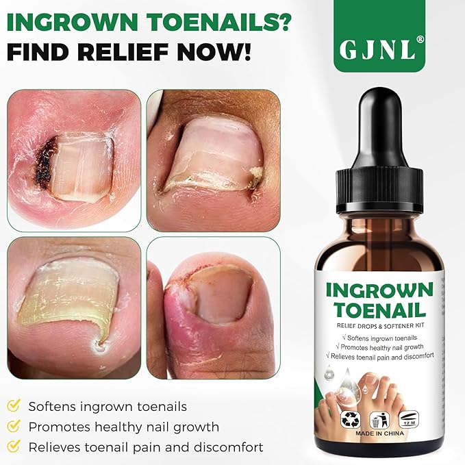 Ingrown Toenail Kit - Ingrown Toenail Drops, Ingrown Toenail Set - 60 Pcs Toenail Straightener Strips -Toenail Lifter Small Scissors