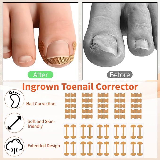 Ingrown Toenail Removal Kit, Ingrown Toenail Tool Kit Corrector with Ingrown Toenail Correction Strips, Toe Separators, Painless File and Lifter for Home Pedicure Care