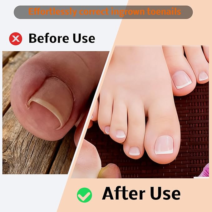 Ingrown Toenail Corrector Kit with Correction Strips, Breathable Ingrown Toenail Tape, Removal Kit for Ingrown Toenails in Women And Men