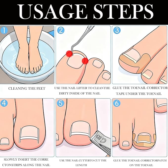 Ingrown Toenail Corrector Set with Correction Strips,Professional Ingrown Toenail Tool kit,Curved Toenails Corrector Patch,For Home Pedicure Care