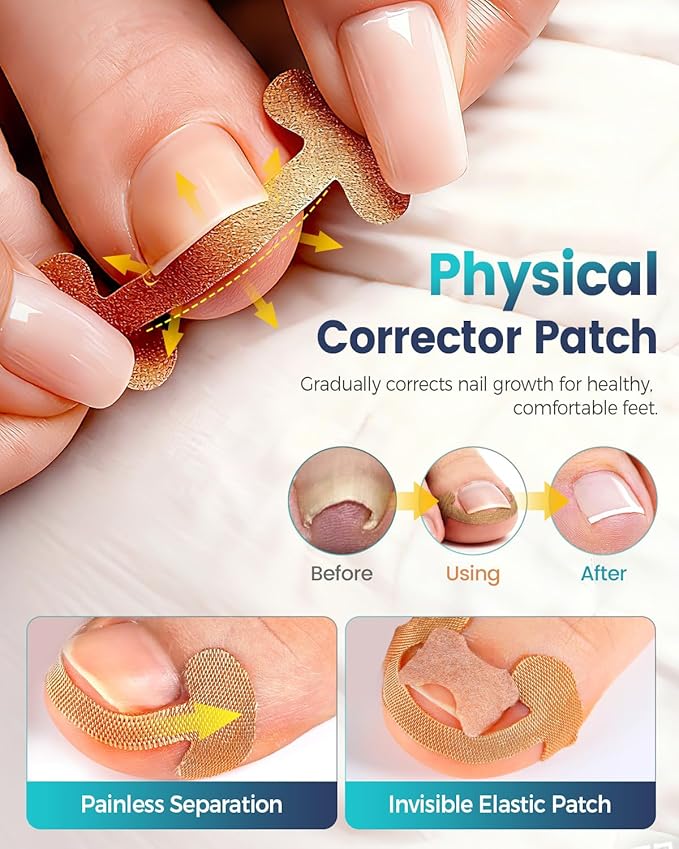 Professional Ingrown Toenail Corrector, 2-in-1 Ingrown Toenail Removal Kit with U-Shaped Strips and Correction Patch, Ingrown Toenail Clippers Tool Set- Effective Removal of Ingrown Toenails (Gold)