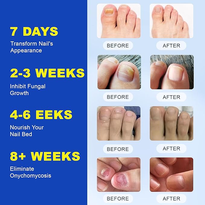 Toenail Fungus Treatment Patches - 21 Pcs Fungal Nail Patches, Extra Strength 8-Hour Formula, for Discolored & Damaged Toenail Care, Overnight Renewal for Men & Women (1 Pack)