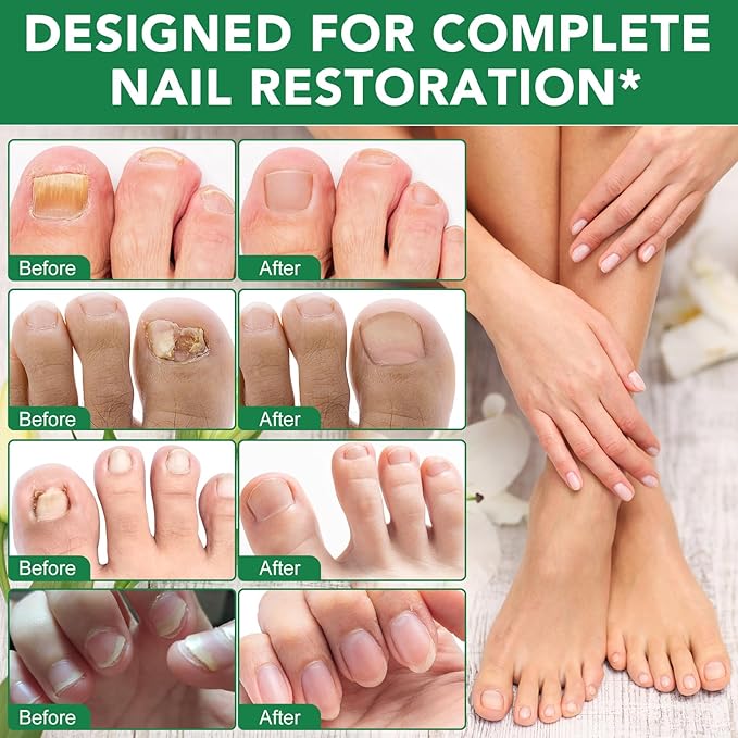 Toenail Treatment Extra Strength - 32 Pcs Nighttime Nail Patches for Toenails - Toe Nail Treatments for Nails Repair & Care - Easy to Use