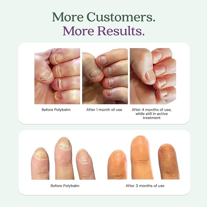 CLINICALLY PROVEN for Weak, Brittle, Damaged Nails | 100% Natural Nail Repair Balm | Doctor Developed to Strengthen Nails Damaged by Gel or Nail Salon Manicures, Menopause & Aging | Made in the UK