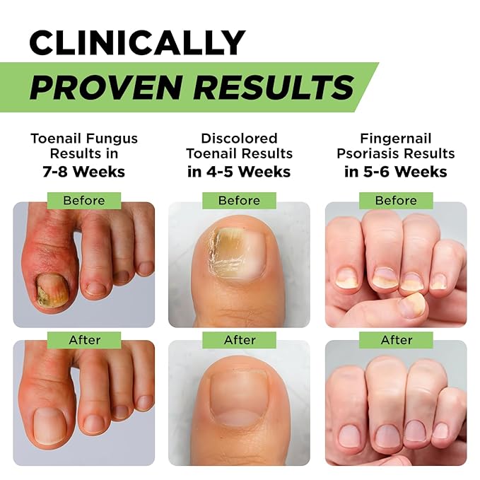 Footcure Antifungal Nail Treatment Pen – Extra Strength Toenail Fungus Treatment, 25% Undecylenic Acid for Toenails & Fingernails, Nail Fungus Repair Pen with Tea Tree & Oregano Oil, Made in USA