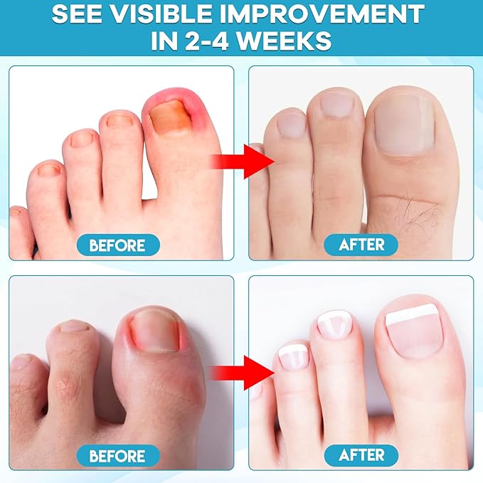 Ingrown Toenail Drop - Ingrown Toenail Pain Reliever and Softener Kit for Men Women Ingrown Toenail Corrector Drops
