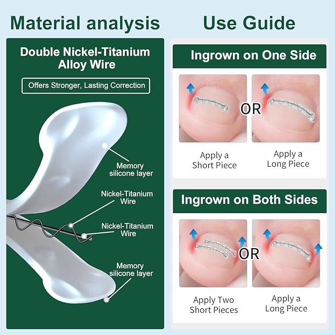 Dual Nitinol Ingrown Toenail Corrector,Ingrown Toenail Treatment,Curved Toenail Straightener,Ingrown Toenail Removal Kit,Big Toe Ingrown Toenail Tool (0.55in,0.66in)