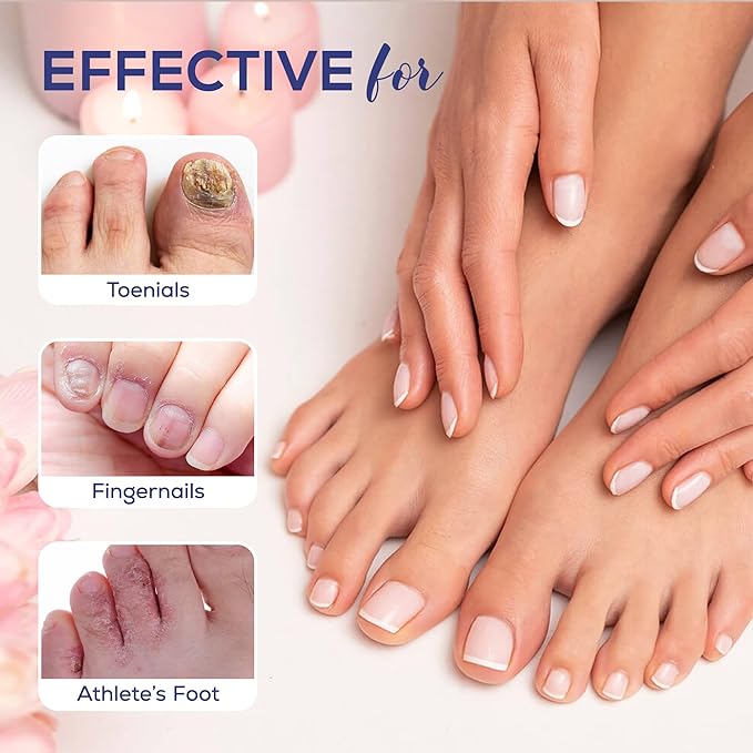 Toenail Fungus Treatment Extra Strength: 25% Undecylenic Acid Toe & Fingernail Fungus Renewal - Nail Fungus Treatment Kit with Brush & File - For Ingrown Nails & Discoloration