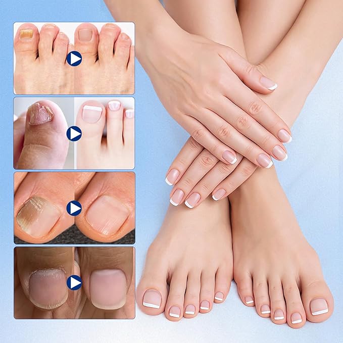 Toenail Fungus Treatment Extra Strength - 21 Pcs Fungal Nail Patches, nail repair patches-8-Hour Firm Adhesion, Nail Repair patches for Damaged Nails, Overnight Renewal for Men and Women