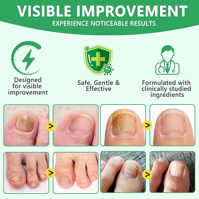 Ginger Nail Growth Serum,Ginger Cuticle Care Oil for Strengthen & Promote Nails Growth, Natural Plant Formula