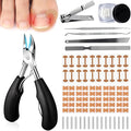 Professional Ingrown Toenail Corrector, 2-in-1 Ingrown Toenail Removal Kit with U-Shaped Strips and Correction Patch, Ingrown Toenail Clippers Tool Set- Effective Removal of Ingrown Toenails (Silver)