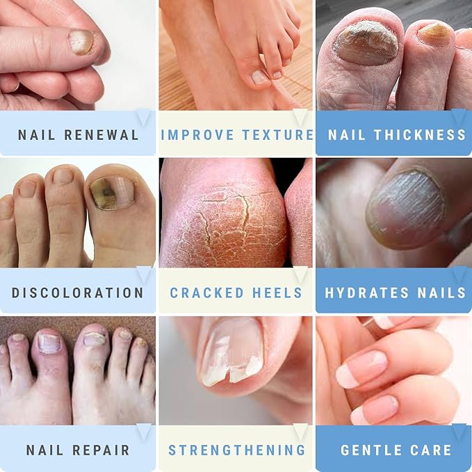 Urea 50% Nail Gel - Softens Cracked Heel Calluses & Thick Toenails - Repairs Damaged, Yellow, Discolored Nails – Highly Effective & Quick-Dry Fingernails & Toenail Treatment