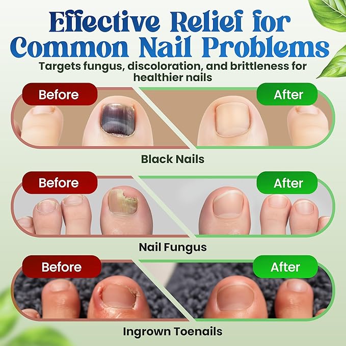 Premium Fungal Nail Patches Toe Nail Care Extra Fungus Strength 21 Pcs Nighttime Repair Damaged Treatment Toenail ingrown Nails 8 Hour Safe Sensitive gift for Valentine Day Women Men .(21 Count)