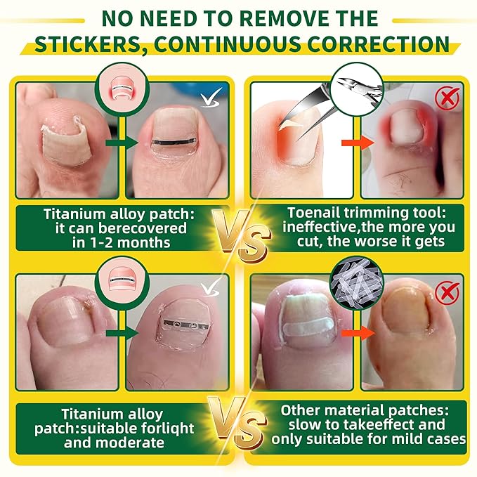 Small Size-Titanium Alloy Ingrown Toenail Treatment & Removal Kit for Quick Relief, Ingrown Toenail Removal Kit， Professional Ingrown Toenail Corrector, Ingrown Toenail Tools for Quick Relief, 10 Pcs