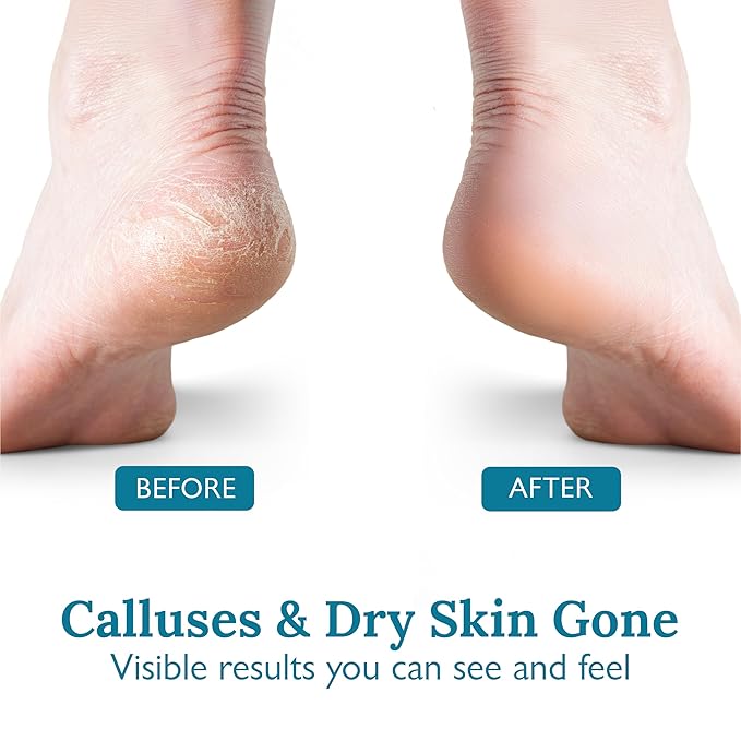 Gilden Tree Foot Callus Remover Kit - 40% Urea Cream & Handmade Terra-Cotta Pumice Stone for Feet - Callus Remover for Feet with Shea Butter & Aloe Vera - Cracked Heel Treatment & Moisturizer