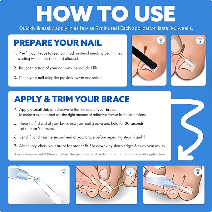 CurveCorrect® Ingrown Toenail Treatment Kit - Ingrown Toenail Corrector Kit with 10 Braces - at Home Ingrown Toenail Correction - Big Toe Ingrown Nail Removal