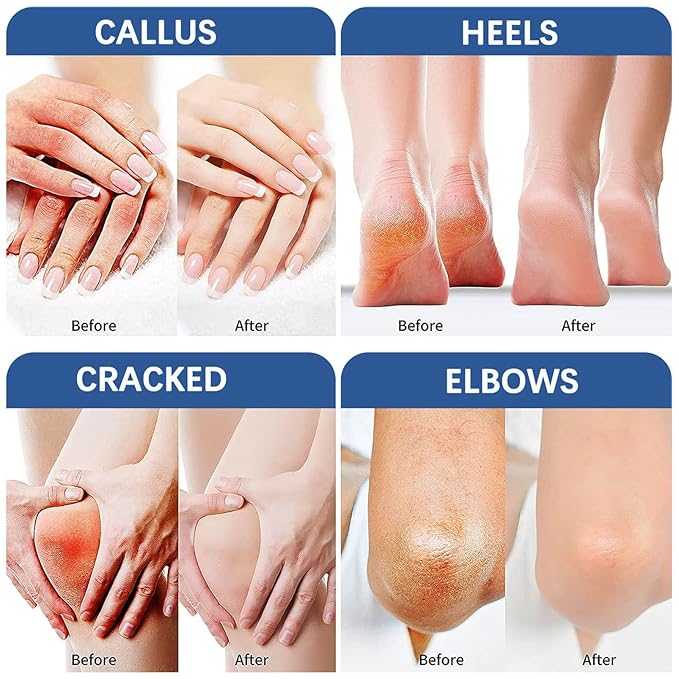 NovaCharm 45% Urea Cream with 2% Acid, Urea Foot Cream 45 Percent for Feet & Hands - Maximum Strength Foot Moisturizer for Rough, Dry, Thick & Cracked Skin, Callus Remover, Deep Hydration