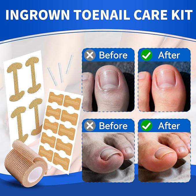 Ingrown Toenail Care Kit with Flexible Strips(134PCS), Professional Toenail Tool Kit Includes Breathable Toenail Bands, Curved Pads, Painless File & Lifter Tools | Home Pedicure Maintenance Set