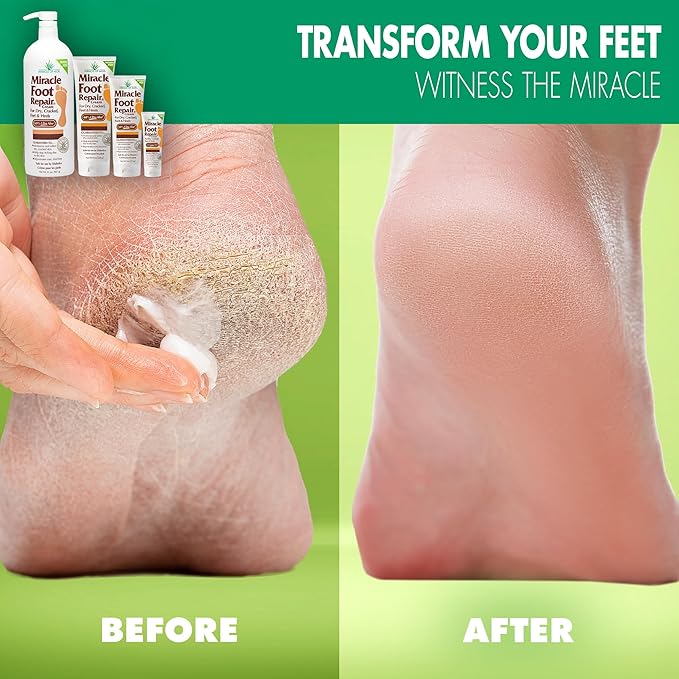 Miracle Foot Repair Cream (32 oz) Repairs Dry Cracked Heels and Feet, 60% Pure UltraAloe Moisturizes, Softens, and Repairs