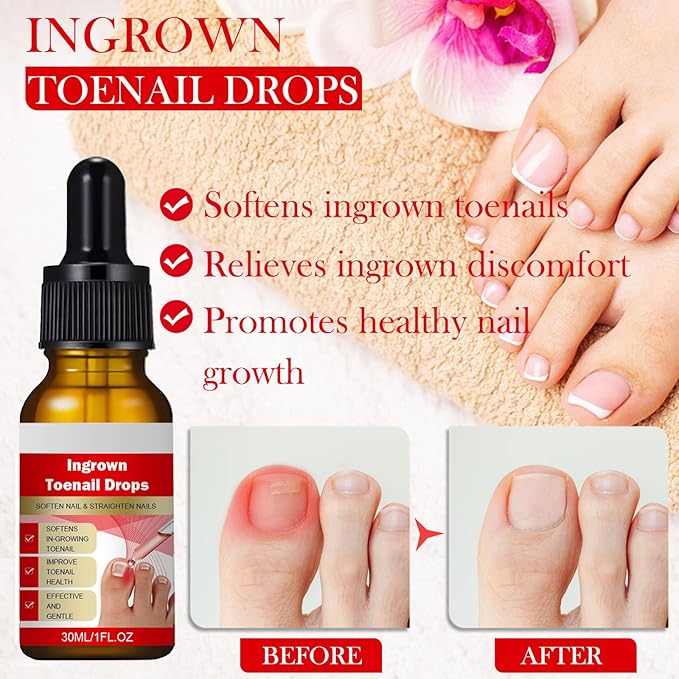 Ingrown Toenail Removal Kit, Professional Ingrown Toenail Treatment, Ingrown Toenail Tools Kit with Ingrown Toenail Corrector Drops, Toenail Clipper, Corrector Patch, Stainless Steel Pedicure Tool Set