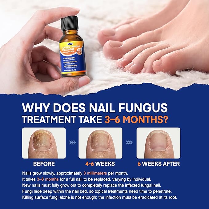 Toenail Fungus Treatment with 25% Undecylenic Acid: Toenail Fungus Treatment Extra Strength for Thick, Yellow and Damaged Nails - Safe and Gentle for Nails Care