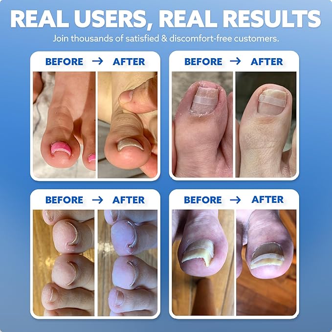 CurveCorrect® Ingrown Toenail Treatment Kit - Ingrown Toenail Corrector Kit with 10 Braces - at Home Ingrown Toenail Correction - Big Toe Ingrown Nail Removal