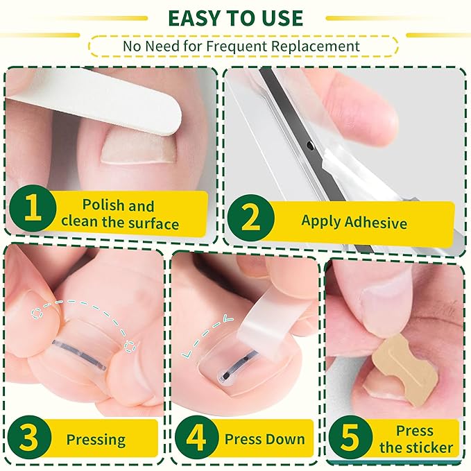 Small Size-Titanium Alloy Ingrown Toenail Treatment & Removal Kit for Quick Relief, Ingrown Toenail Removal Kit， Professional Ingrown Toenail Corrector, Ingrown Toenail Tools for Quick Relief, 10 Pcs