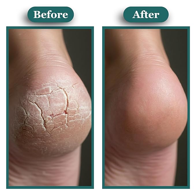 Kissable Feet, Athletes Foot Cream – Cream for Itchy, Dry Skin – Tea Tree, Coconut & Chamomile – Crafted for the Whole Family, No Sting – 3.5 oz