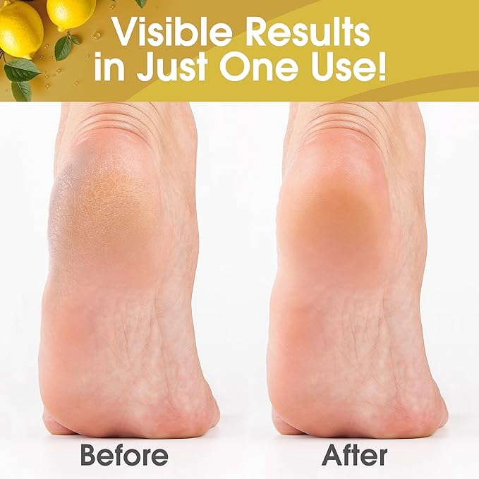 Callus Remover for Feet, Extra Strength Foot Callus Remover Gel, 16oz Salon Grade Home Pedicure Supplies for Dry Skin, Cracked Heel, Professional Strength Foot Care, Lemon